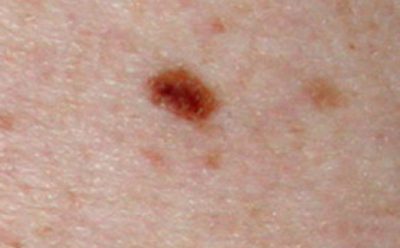Video Intervention May Increase Skin Cancer Diagnosis in 